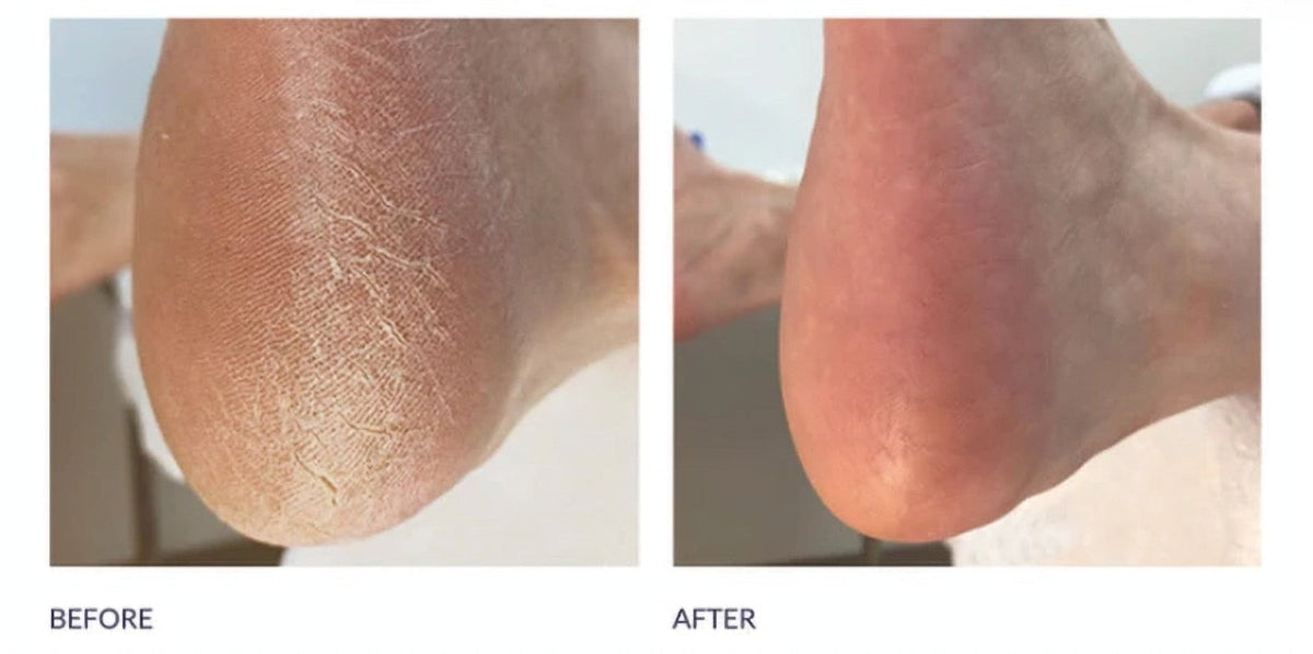 Footlogix Callus Softener & File Combo infographic